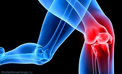 Arthrose