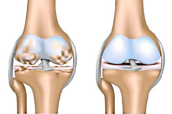 Gesunde Gelenk und Arthrose