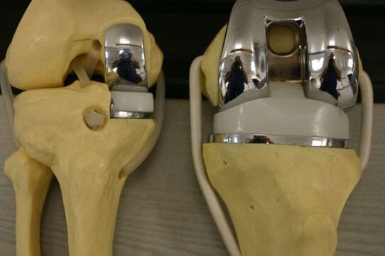 Varianten der Endoprosthetik des Kniegelenks