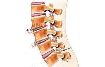 Spondylarthrose als Ursachen von Rückenschmerzen