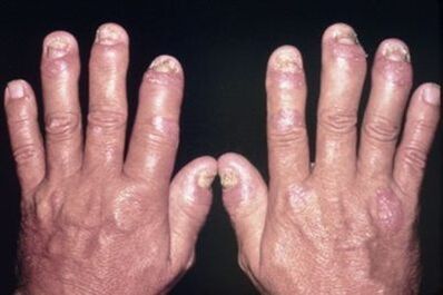 Warum weh die Fugen der Finger weh