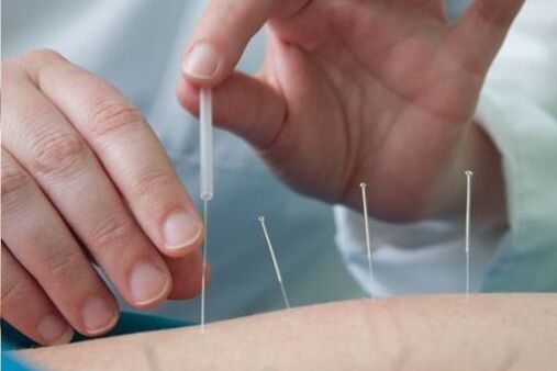 Akupunktur ist eine Methode zur Behandlung von Schmerzen im Lendenbereich, die durch Osteochondrose verursacht werden