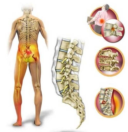 Osteochondrose der Lendenwirbelsäule, die Schmerzen im unteren Rückenbereich verursacht
