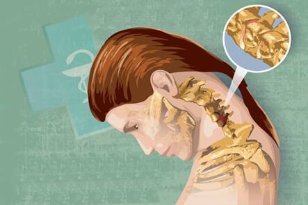 Reflexsymptome der Osteochondrose