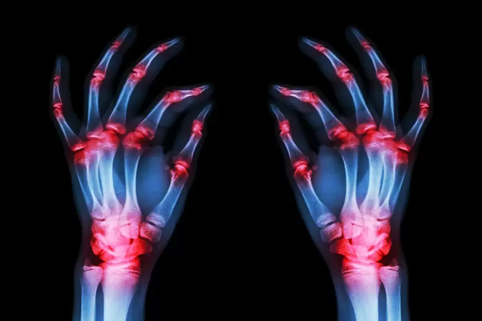 Arthrose der Fingergelenke