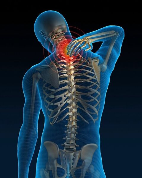 In der Anfangsphase der Behandlung der zervikalen Osteochondrose nehmen die Schmerzen im Nacken zu