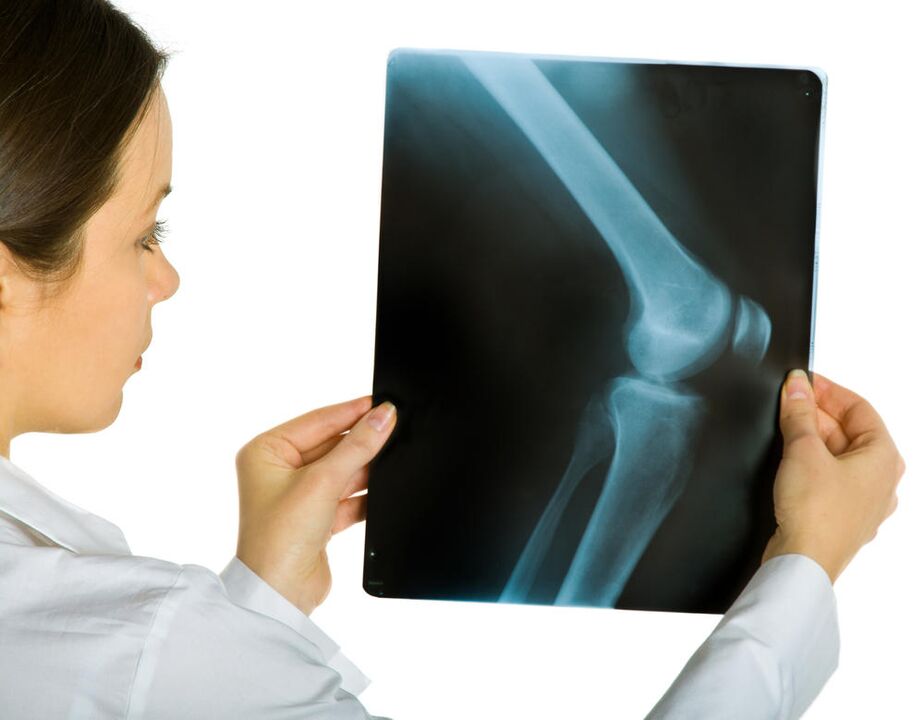 Eine Röntgenaufnahme des Kniegelenks zeigt das Vorhandensein einer deformierenden Arthrose