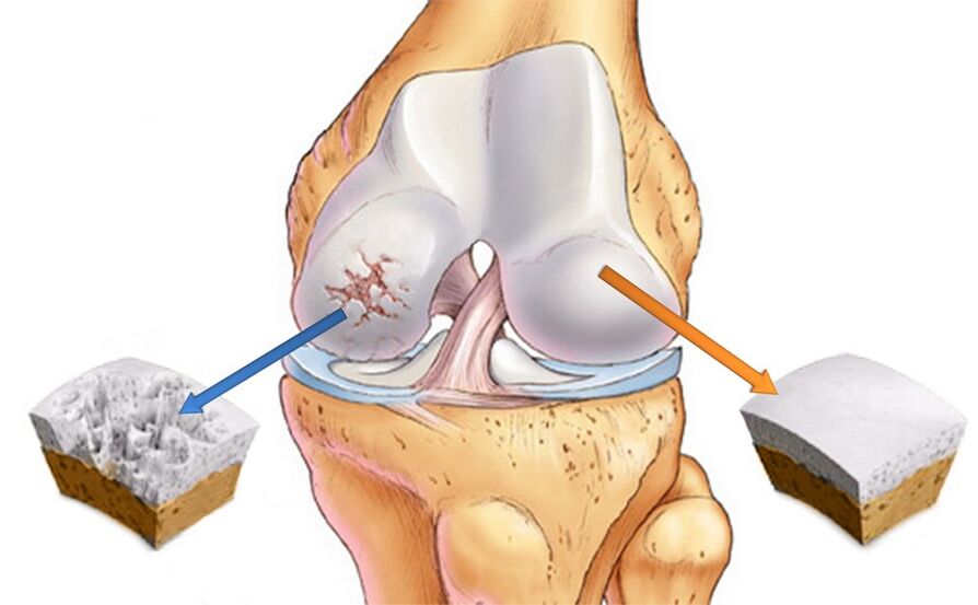 Gesundes Kniegelenk (rechts) und von Arthrose betroffen (links)
